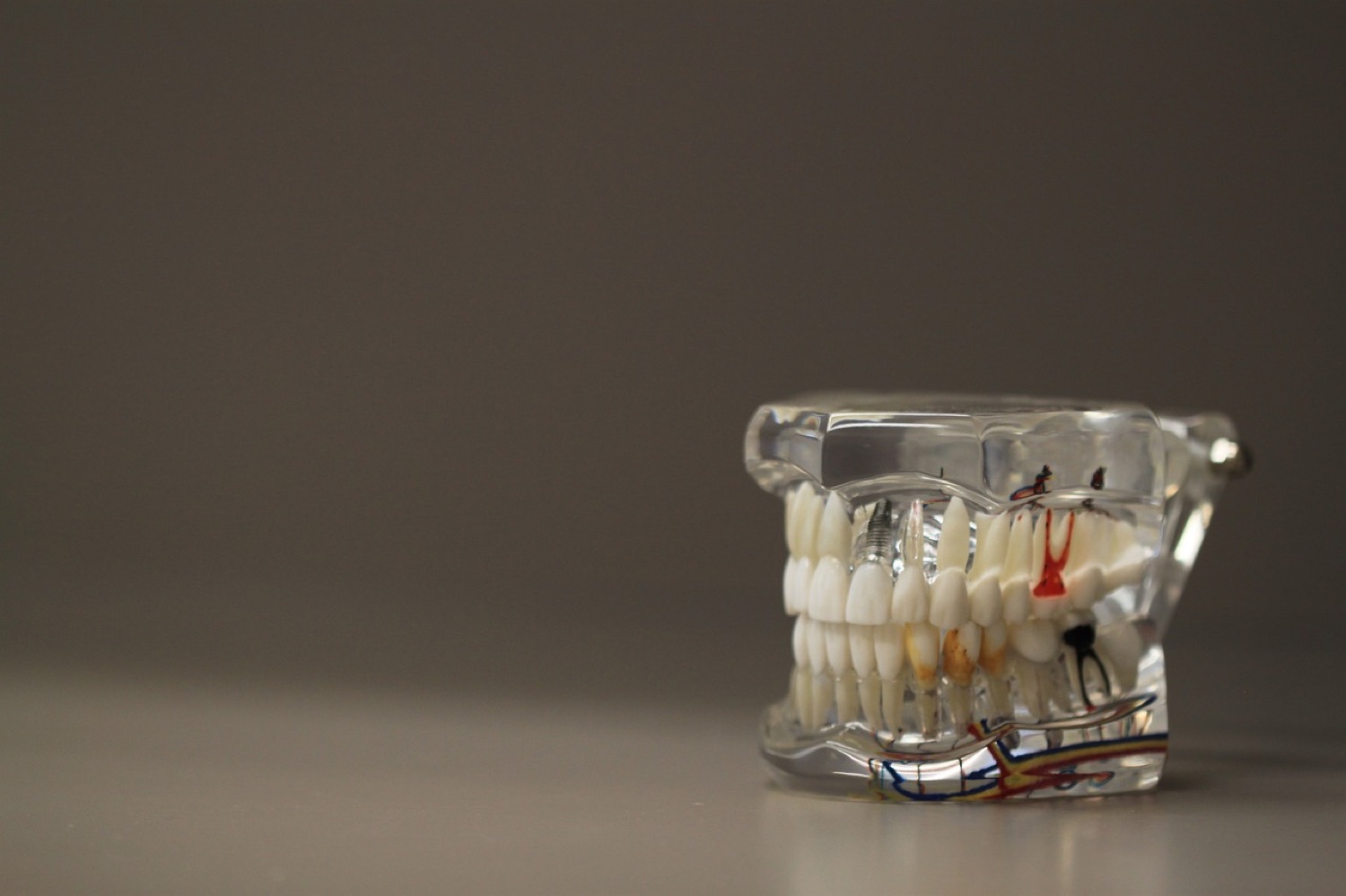 Modello dentale trasparente con impianto – implantologia Paidos
